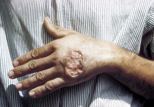 Úlcera cutânea causada pela Leishmaniose num adulto da América Central