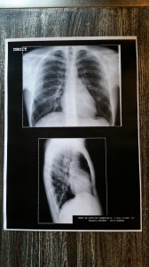 Radiografia de Rui Costa que mostra a broncopneumonia que o afastou da Tour de France 2014