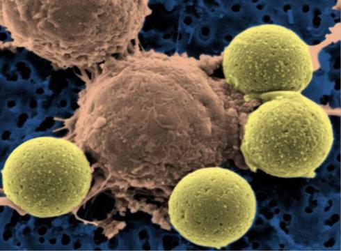 Tratamento tradicional da leucemia: células-T do sistema imunitário (ao centro) ligam-se aos grânulos que provocam a divisão celular
