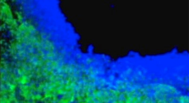 Células estaminais produtoras de toxinas (a azul) ajudam a matar células cerebrais cancerígenas (a verde)