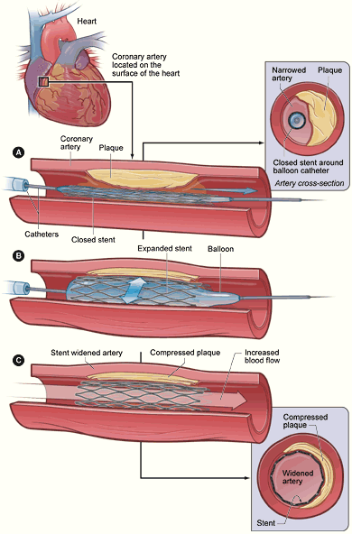 O stent cardiovascular tradicional é instalado na artéria para a manter aberta
