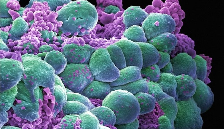 Um cluster de células cancerígenas num cancro de mama