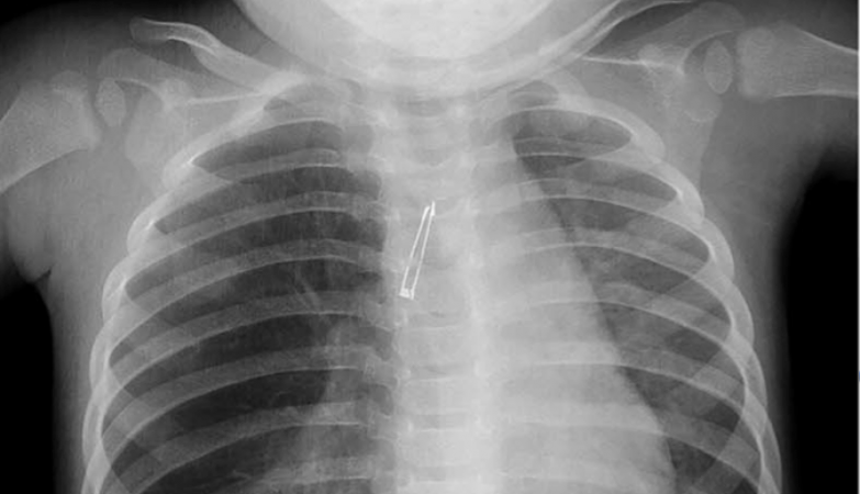 O raio-X que mostra o objecto no brônquio direito da menina