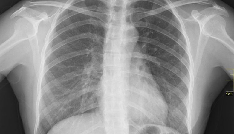 Radiografia raio-x toraxico