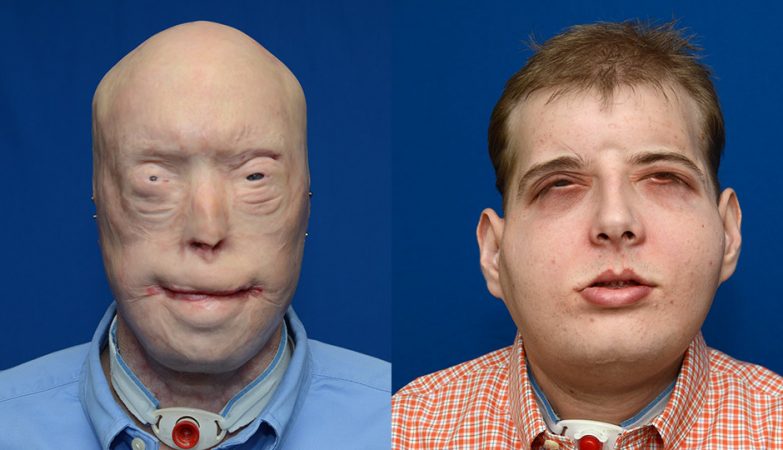 O bombeiro norte-americano Patrick Hardison, antes e depois de ter recebido o maior transplante de cara alguma vez feito