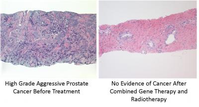 Cancro da próstata avançado antes (esq.) e depois (dir.) do tratamento, quando não restam indícios da doença depois da combinação de terapia genética e radioterapia