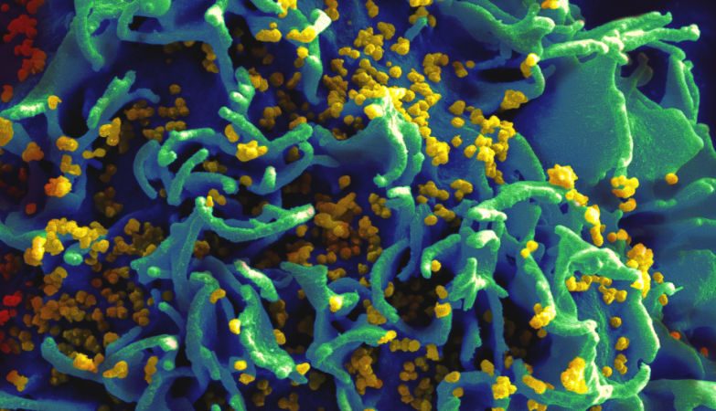 Imagem de microscopia electrónica de partículas de VIH a infectar uma célula T humana.