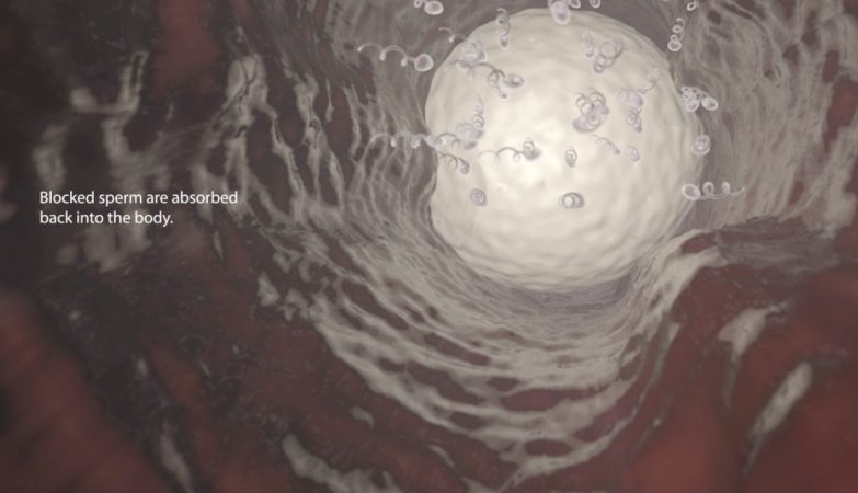 Representação 3D do Vasalgel a bloquear o esperma no canal deferente