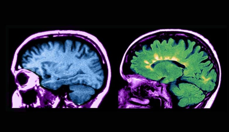 Ressonância magnética de cérebro normal (esquerda) e com esclerose múltipla (direita)