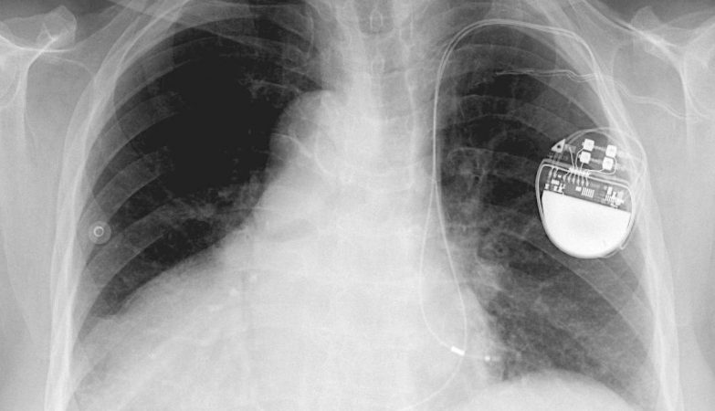 Radiografia de um paciente com um pacemaker